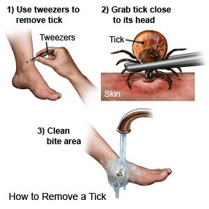 How to Remove a Tick