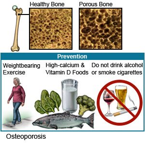 Osteoporosis