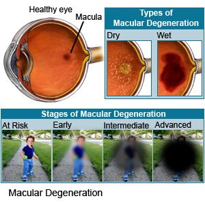 macular degeneration symptoms)