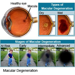 Macular Degeneration What You Need To