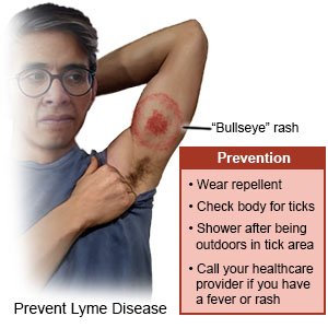 Prevent Lyme Disease