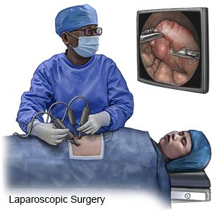 laparoscopic hysterectomy before and after