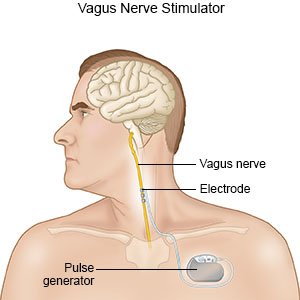 Vagus Nerve Stimulation Device