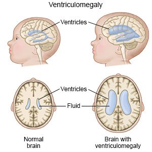 Ventriculomegaly