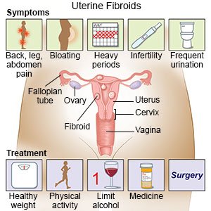 Uterine Fibroid