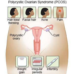 Polycystic Ovarian Syndrome (PCOS)