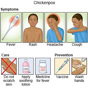 Chickenpox