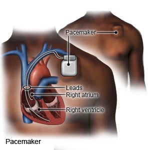 can low blood sugar cause bradycardia