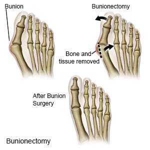 Bunionectomy