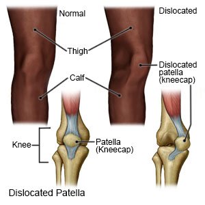 Dislocated Patella