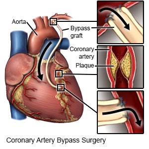Coronary Artery Bypass Surgery (CABG)
