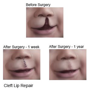 Cleft Lip Repair