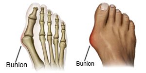 Bunion