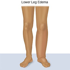 Lower Leg Edema