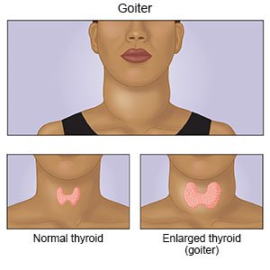 Goiter