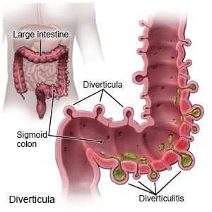 diverticulitis