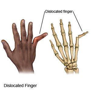 Dislocated Finger