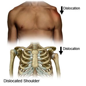 Dislocated Shoulder