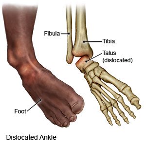 Dislocated Ankle