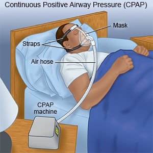 Continuous positive airway pressure