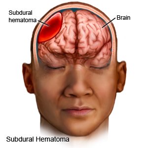 Subdural Hematoma