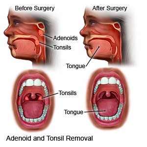 Adenoid and Tonsil Removal