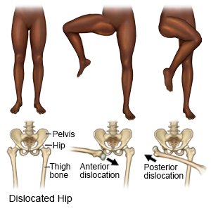 Dislocated Hip