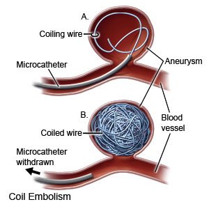 Coil Embolization