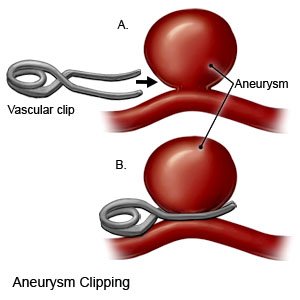 Aneurysm Clipping