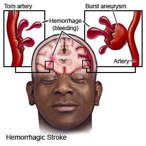 Hemorrhagic Stroke