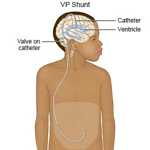 Ventriculoperitoneal Shunt Placement for Hydrocephalus in Adults