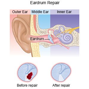 Eardrum Repair