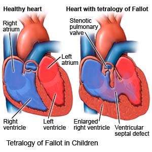Tetralogy of Fallot in Children