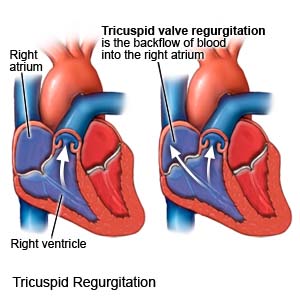 Tricuspid Regurgitation