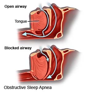 Obstructive Sleep Apnea