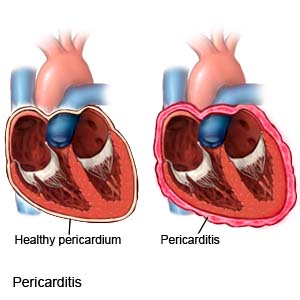 Pericarditis