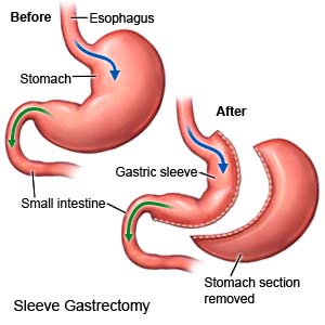 Sleeve Gastrectomy