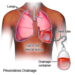 Pleurodesis Drainage