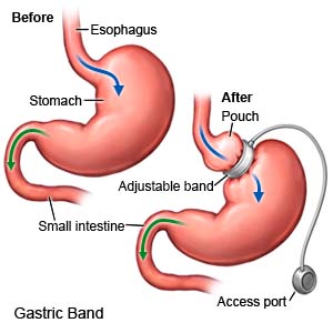 Gastric Band