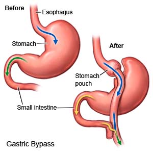 Gastric Bypass