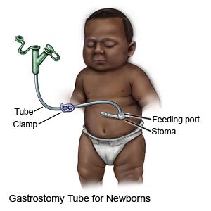 Gastrostomy Tube for Newborns