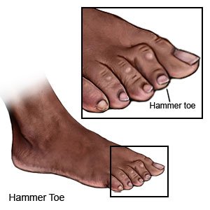 Hammertoe Correction (Discharge Care)