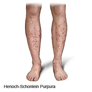 Henoch-Schonlein Purpura