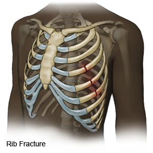Rib Fracture