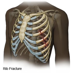 Rib Fracture - What You Need to Know