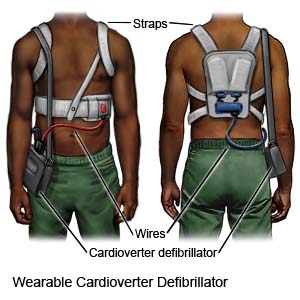 Wearable Cardioverter Defibrillator