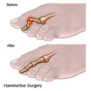 Hammertoe Surgery