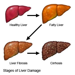 Fatty Liver Disease