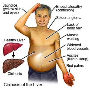 liver cirrhosis symptoms