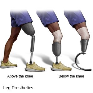 Leg Prosthetics
